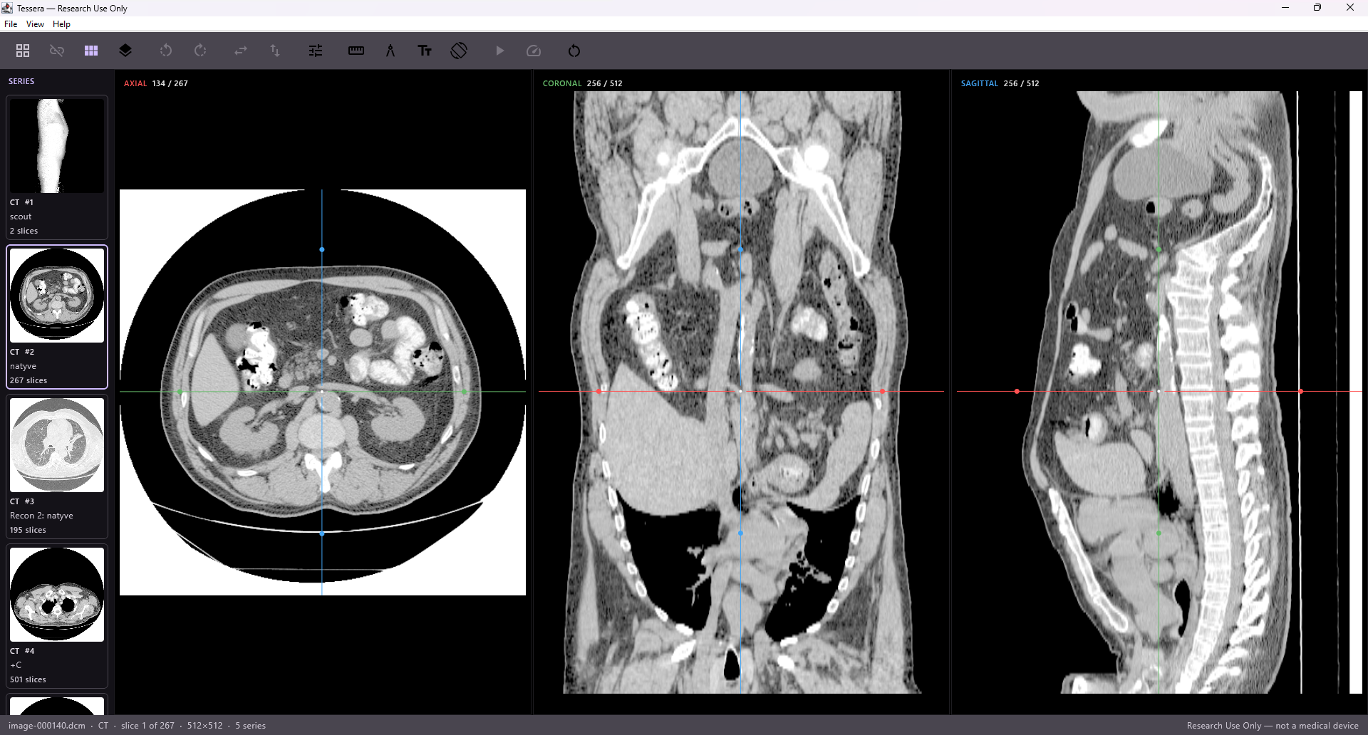Tessera DICOM viewer showing a CT abdomen study in multi-planar reconstruction — linked axial, coronal, and sagittal views with crosshairs and a series thumbnail rail.